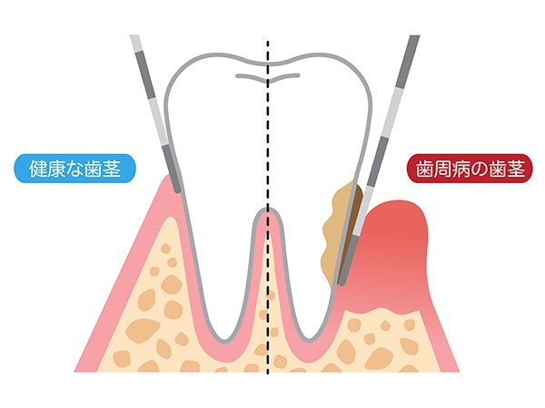 歯周病の治療について